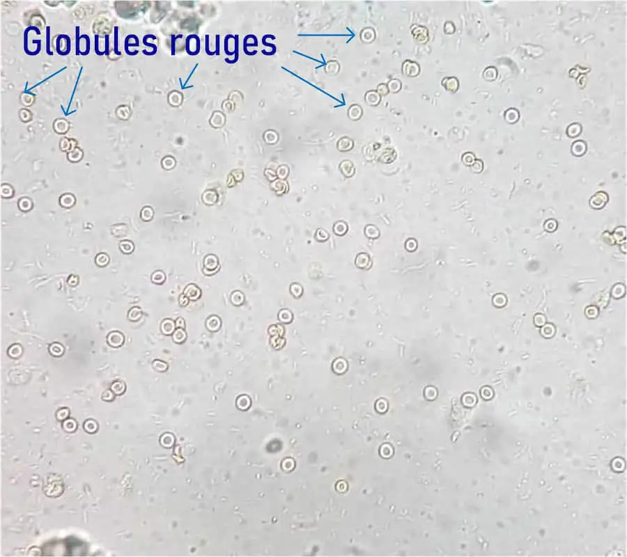 État frais d'urine, observé au microscope avec un grossissement de X40, montrant la présence de nombreuses globules rouges.
