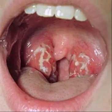 mononucléose infectieuse 