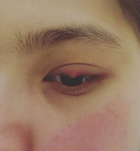 stye