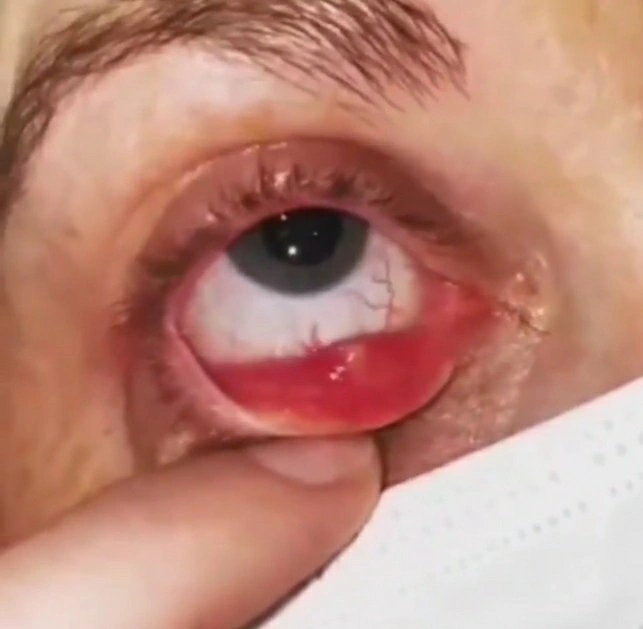 Internal stye