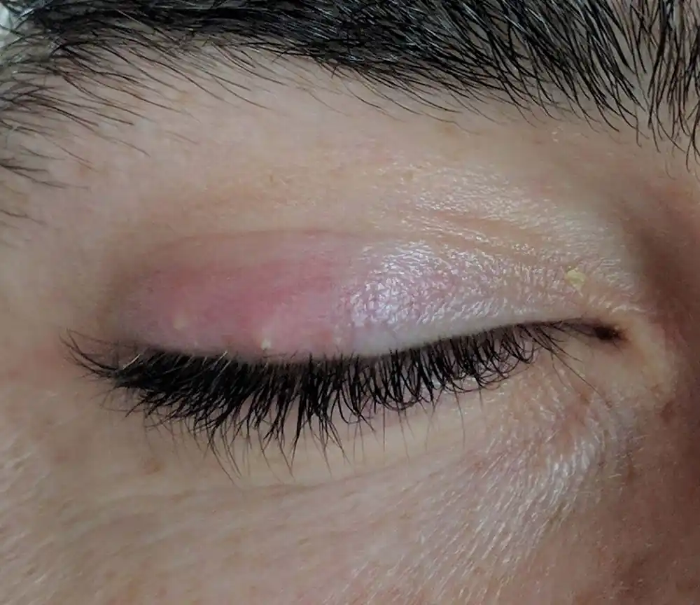Stye
