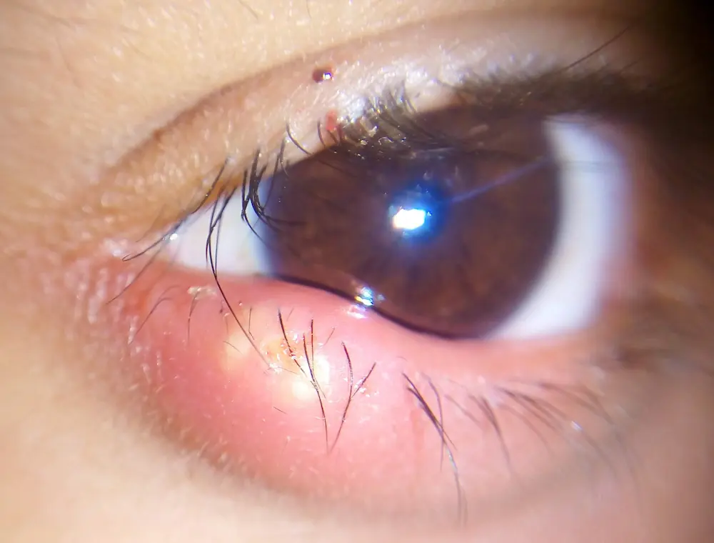 External stye