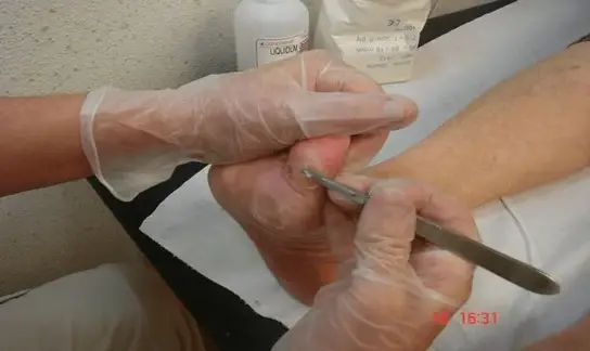 Débridement du pied diabétique