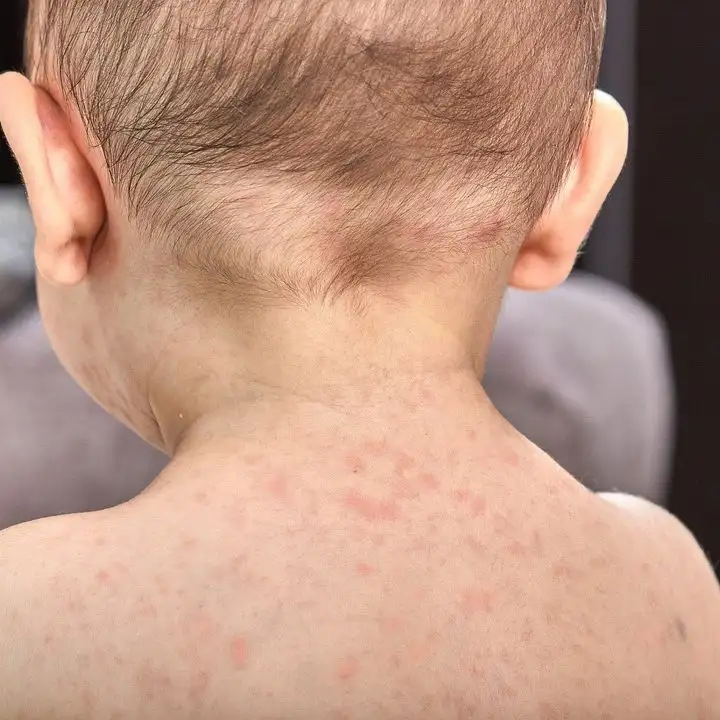 roseola rash