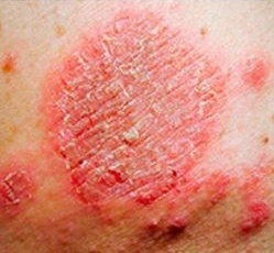 Scarlet fever rash