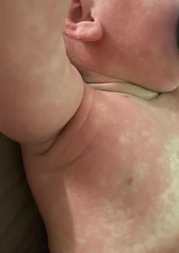 baby scarlet fever